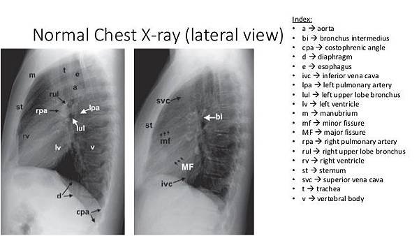 pleural-effusionxray-findings-5-638.jpg