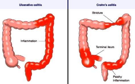 IBD-comparison-location.jpg