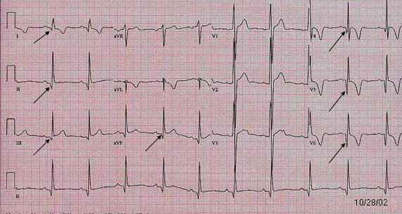 hocm 2- pseudo q, less labelled.jpg