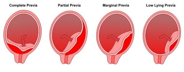 placenta previa.jpg