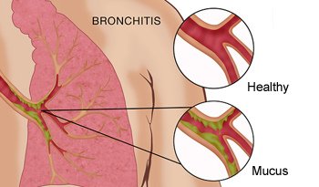 S_0616_bronchitis_C0276597_A.jpg