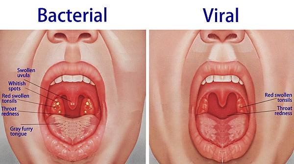 bacterial_and_viral_tonsillitis.jpg