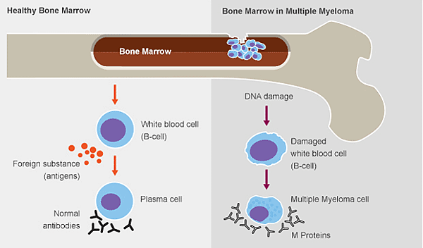 healthy_bone-marrow-and-multiple-myeloma-bone-marrow.png