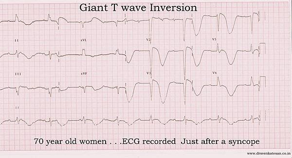 giant-t-wave-inversion-2.jpg