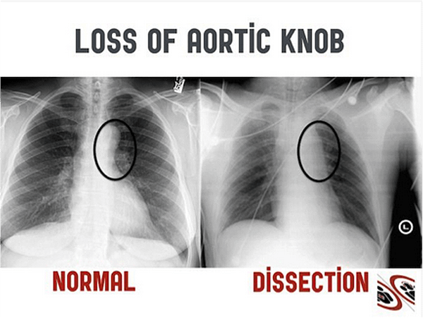 aorticdissectionemc1_orig.png