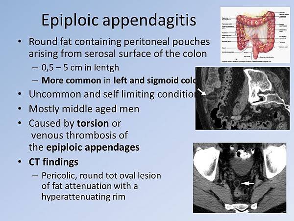 Epiploic+appendagitis.jpg