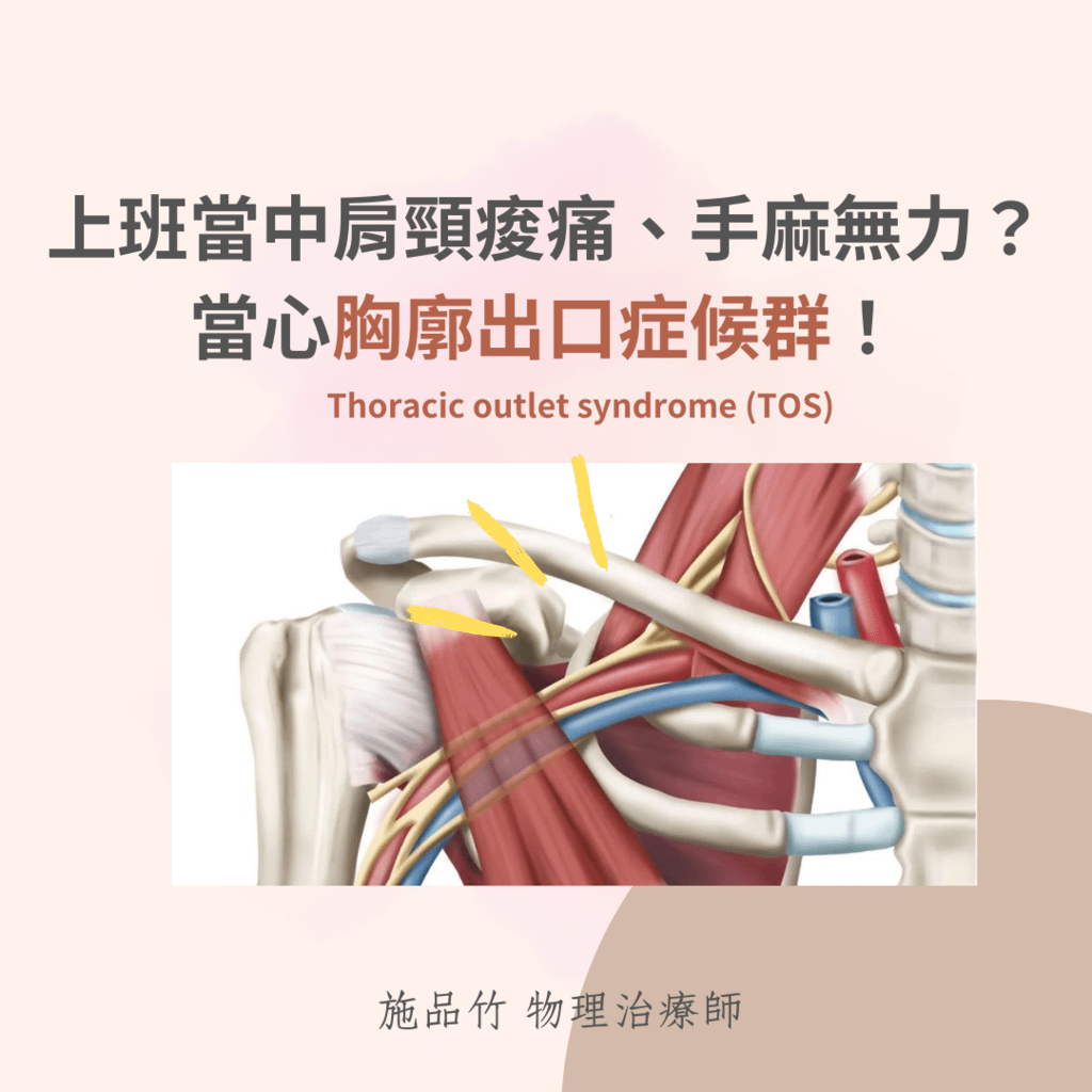 上班當中肩頸痠痛、手麻無力？ 當心胸廓出口症候群！