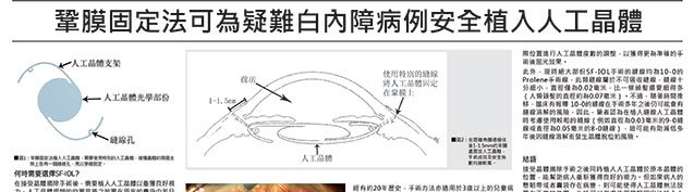 疑難白內障的最佳治療方法：鞏膜固定法.jpg