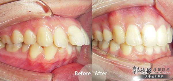 牙齒矯正暴牙問題