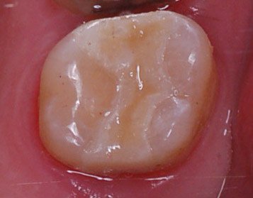 4. cementation 1