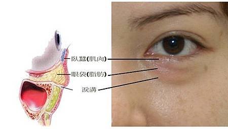 眼袋1-1.jpg
