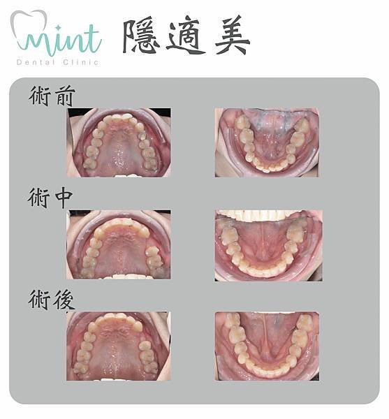 桃園牙醫 → 南崁矯正美容牙科 😁 隱適美隱形式數位牙齒矯正