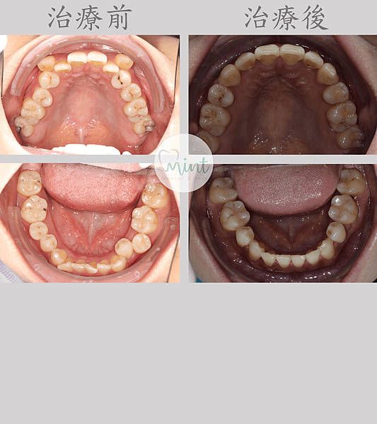 桃園牙醫 → 南崁矯正美容牙科 😁 自鎖式矯正分享33