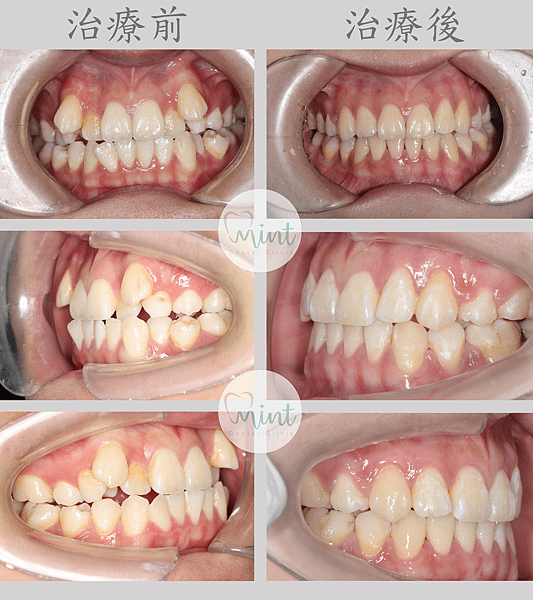 桃園牙醫 → 南崁矯正美容牙科 😁 自鎖式矯正分享33