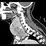 THYROID CT SAGITTAL 4