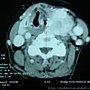 Thyroid CT 2