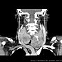 THYROID CT CORONAL 9