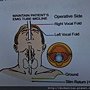 喉返神經監測系統 recurrent laryngeal nerve monitor system