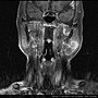 MRI PAROTID TUMOR CORONAL