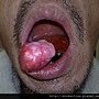 下嘴唇巨大脂肪瘤 lipoma, lip