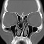 DNS concha bullosa CT coronal 1.jpg