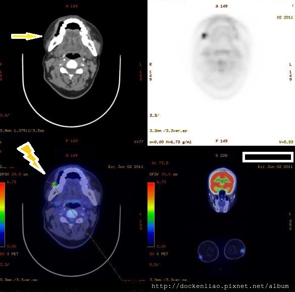 right buccal ca PET CT 7206907 masked.jpg