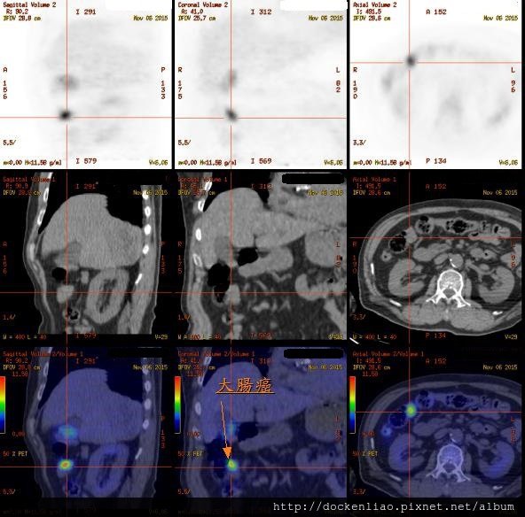 colon ca PET CT 大腸癌