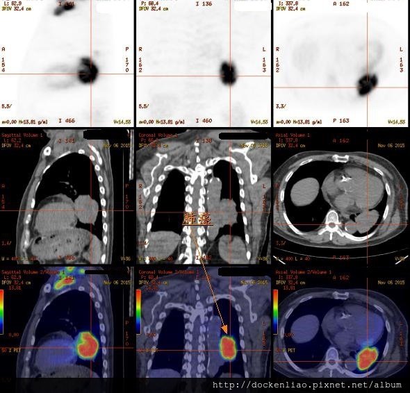 Lung cancer PET CT 肺癌