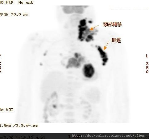 明顯的肺癌與巨大的頸部淋巴腺轉移 PET neck meta Lung ca