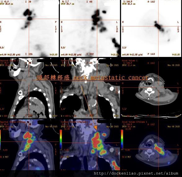 頸部淋巴癌症轉移 Neck metastatic cancer PET CT