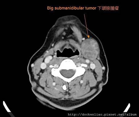 唾液腺 下頷腺 腫瘤 submandibular tumor CT axi
