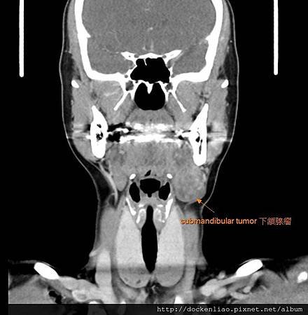 唾液腺 下頷腺 腫瘤 submandibular tumor CT cor2