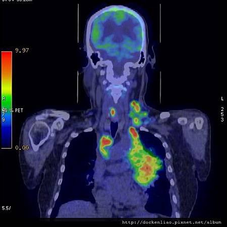 聲音沙啞 左側聲帶麻痺 左側肺癌 PET CT 8 LUNG CA NECK META LT VCP