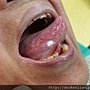 舌頭白斑 tongue leukoplakia 2016