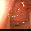 腺樣體肥大 長期鼻塞 增殖腺 adenoid hypertrophy