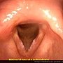 聲帶白斑 可能是早期喉癌 bil vocal leukoplakia