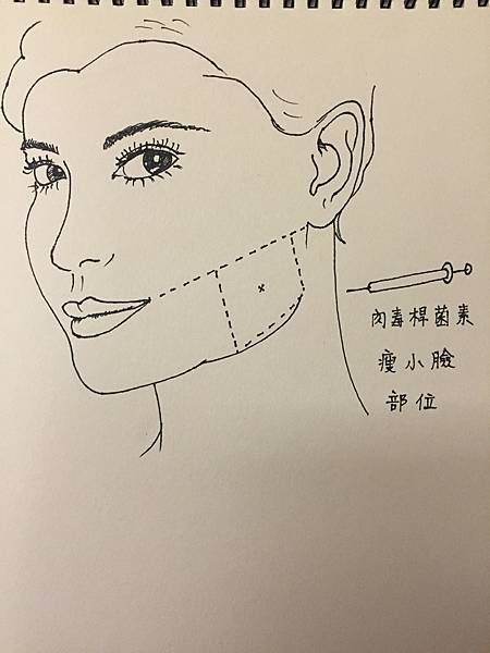 BOTOX