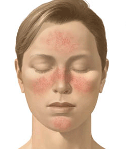 rosacea