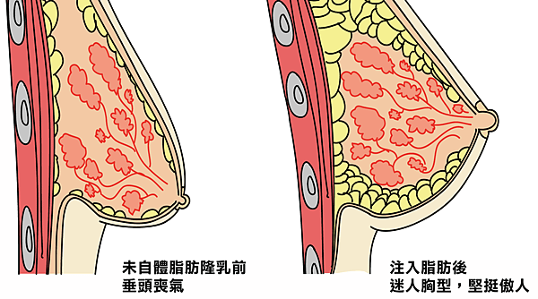 注入前後示意圖著色.png