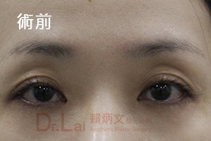 奈米脂肪補眼窩200423_5.jpg