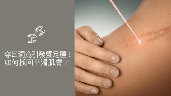 穿耳洞竟引發蟹足腫！如何找回平滑肌膚？