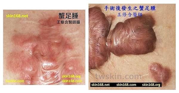 穿耳洞竟引發蟹足腫！如何找回平滑肌膚？