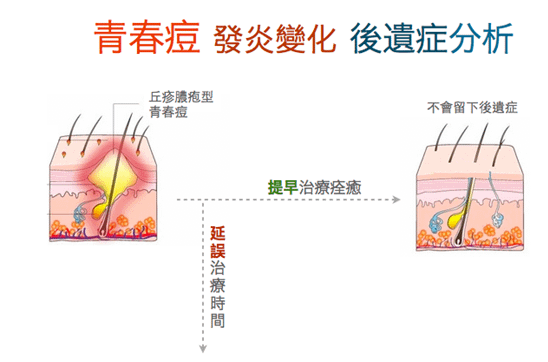 青春痘發炎