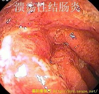 潰瘍性結腸炎