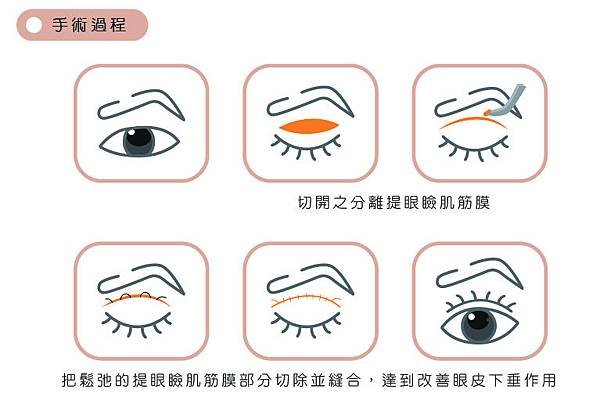 手術過程圖.jpg