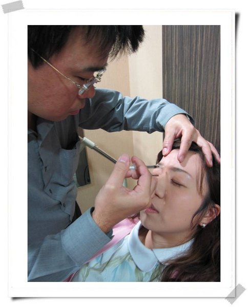 肉毒_除皺眉紋_5.jpg
