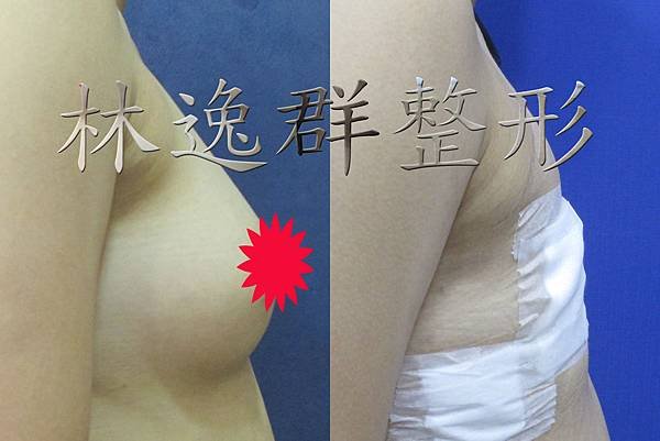 環乳暈乳房切除右面十天