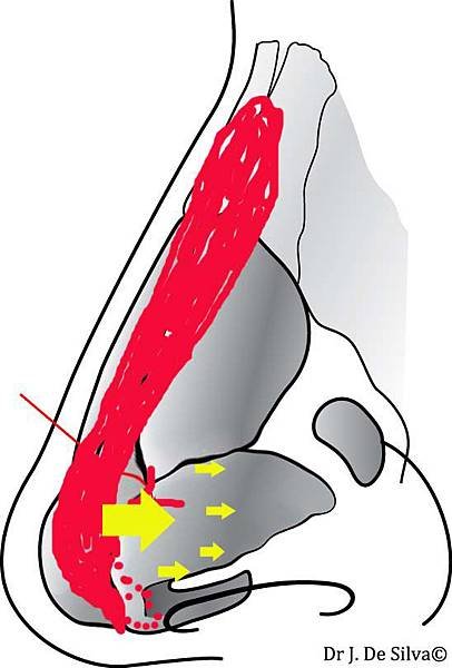 fig4_oblique-Lower-lateral-cartilages3拷貝