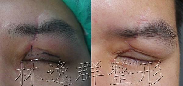 zplasty 眼皮修疤閉眼.jpg