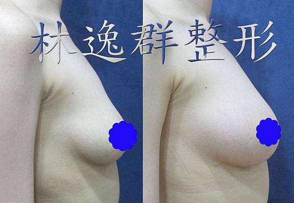 1512xx脂肪隆乳半年右側面拷貝.jpg